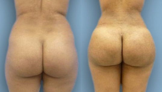 Brazilian Buttocks Augmentation
