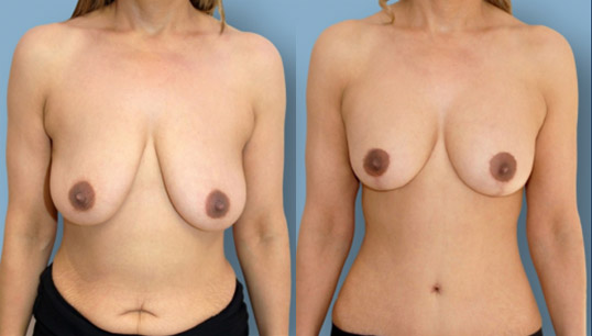Breast lift and abdominoplasty