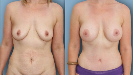 Abdominoplasty and breast augmentation