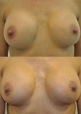 Breast Augmentation & Nipple Reduction