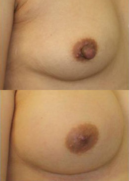 Breast Augmentation & Nipple Reduction