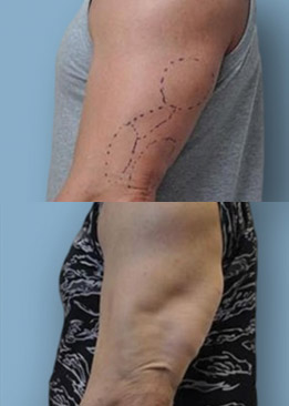 Biceps and Triceps Enhancement Implant
