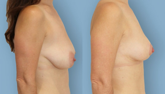 30’s one child, vertical short scar breast lift (mastopexy) and nipple/areola reshaping and repositioning.