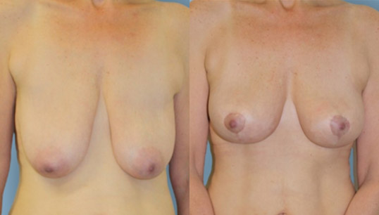 40’s one child, vertical short scar breast lift (mastopexy) and nipple/areola reshaping and repositioning.