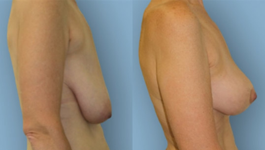 40’s one child, vertical short scar breast lift (mastopexy) and nipple/areola reshaping and repositioning.