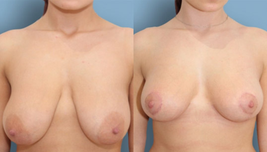 30’s two child, vertical short scar breast lift (mastopexy) and nipple/areola reshaping and repositioning.