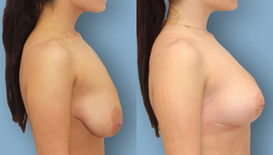 30’s two child, vertical short scar breast lift (mastopexy) and nipple/areola reshaping and repositioning.
