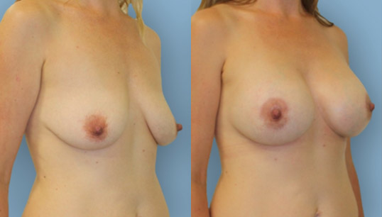 Late 20’s, 3 children, crescentric periareolar breast lift with 360cc high profile breast augmentation