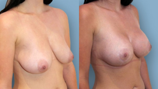Early 30’s, no children, crescentric periareolar breast lift with 360cc high profile breast augmentation