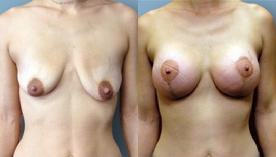 Breast Lift (mastopexy) with augmentation