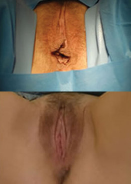 labioplasty