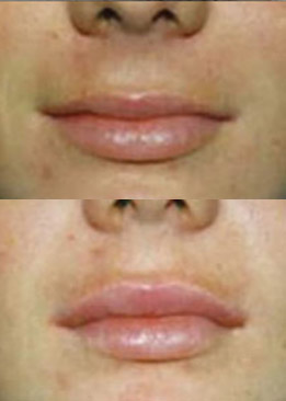 Non-Surgical Lip Augmentation