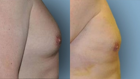 Male Gynecomastia (breast) lipo
