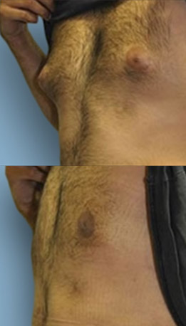 Male Gynecomastia (breast) lipo