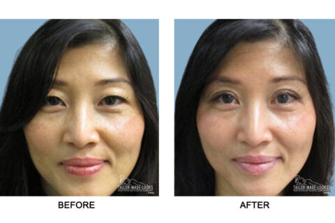 Asian Blepharoplasty Image