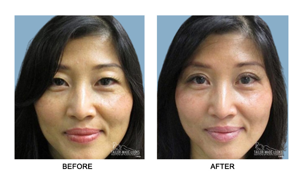 Asian Blepharoplasty Image