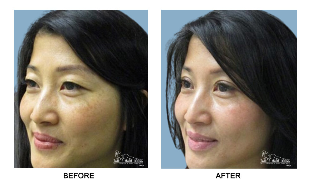 Asian Blepharoplasty Image