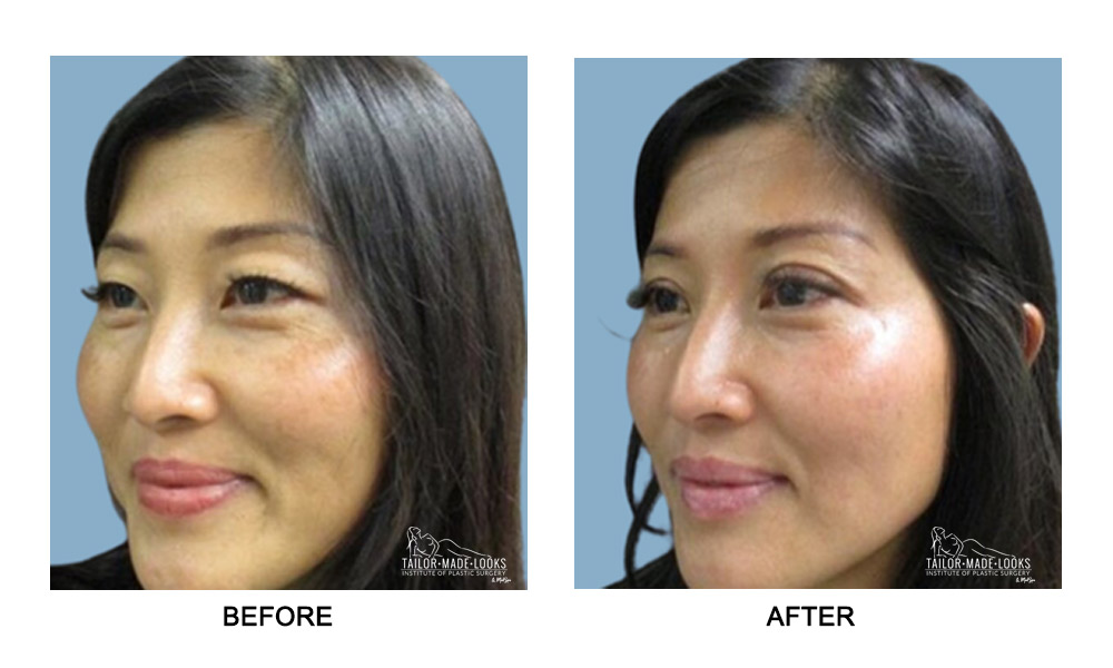 Asian Blepharoplasty Image