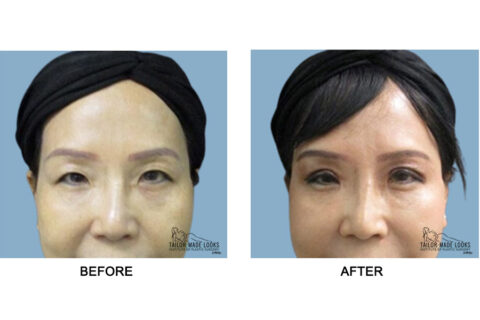 Asian Blepharoplasty Image