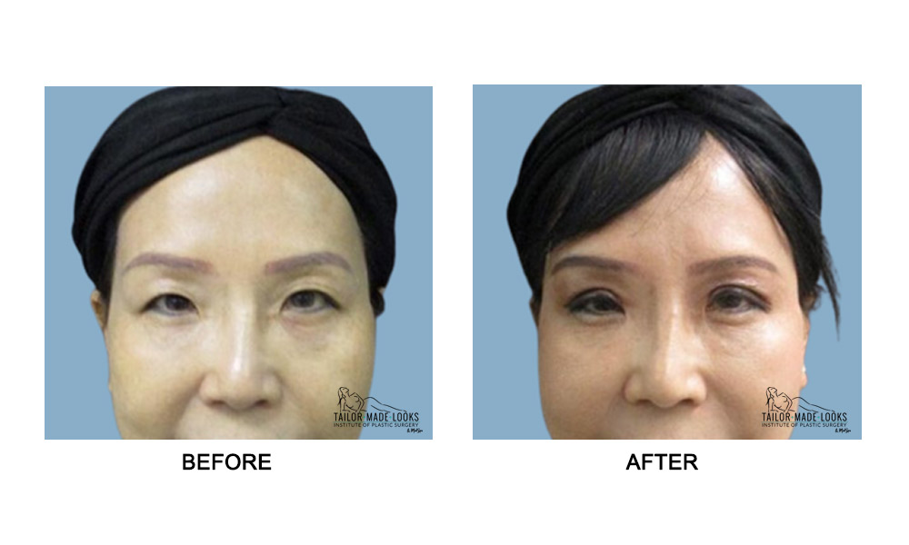 Asian Blepharoplasty Image