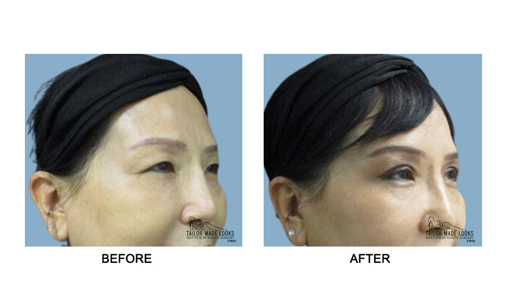 Asian Blepharoplasty Image