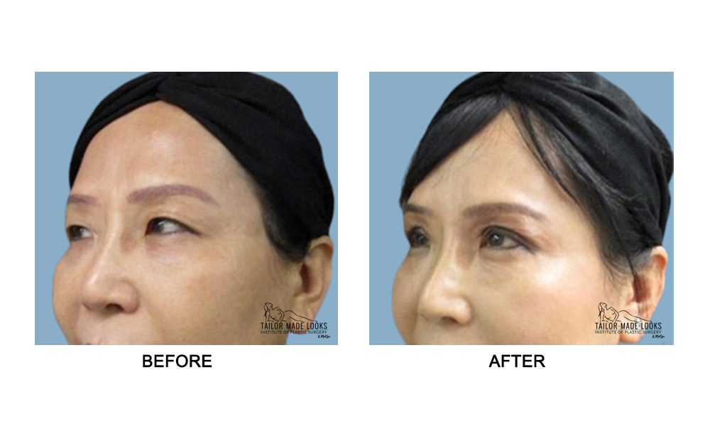 Asian Blepharoplasty Image