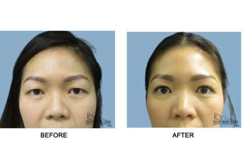 Asian Blepharoplasty Image