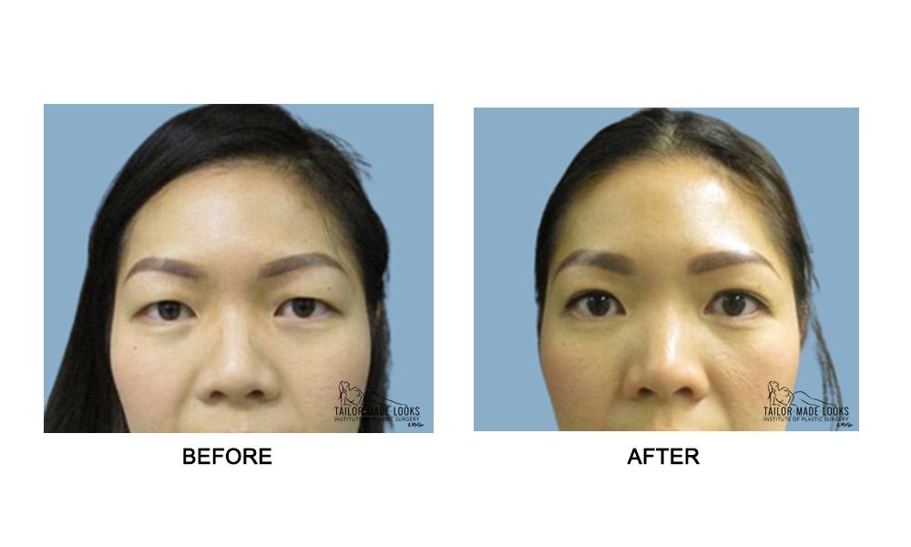 Asian Blepharoplasty Image