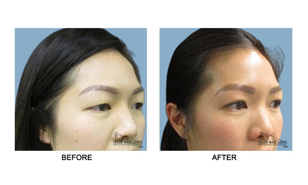 Asian Blepharoplasty Image