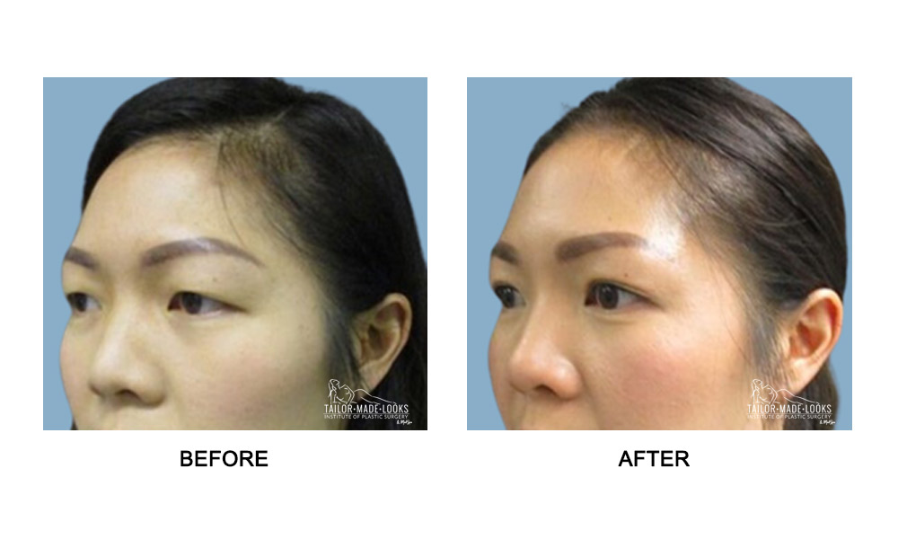 Asian Blepharoplasty Image