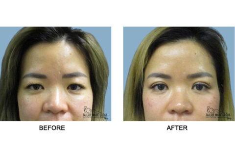 Asian Blepharoplasty Image