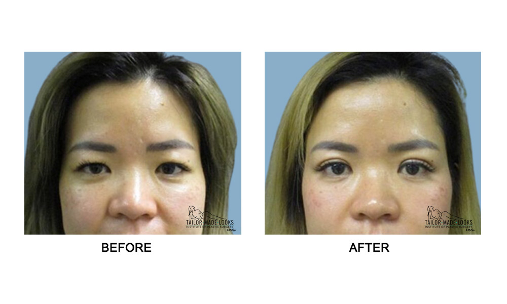 Asian Blepharoplasty Image