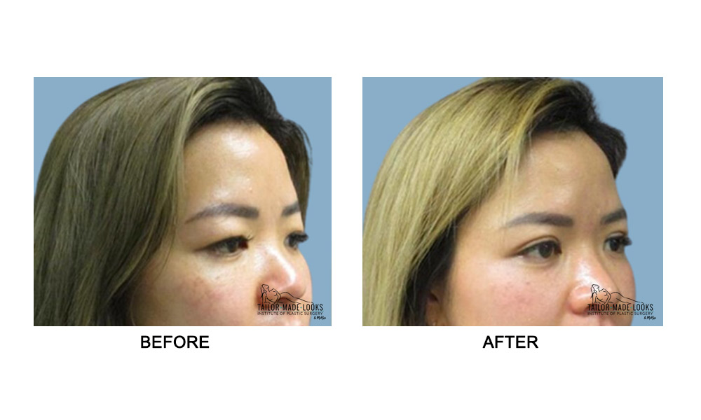 Asian Blepharoplasty Image