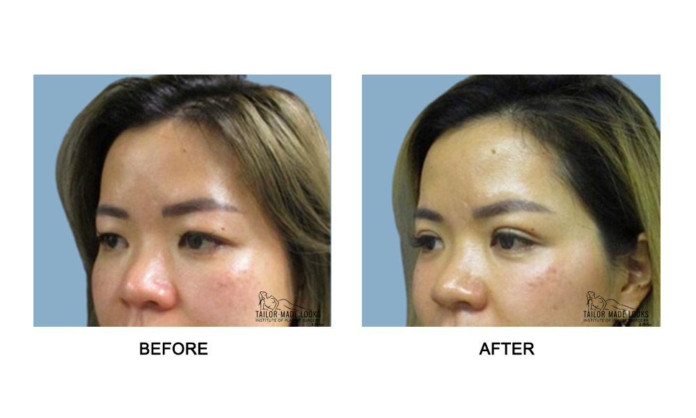 Asian Blepharoplasty Image