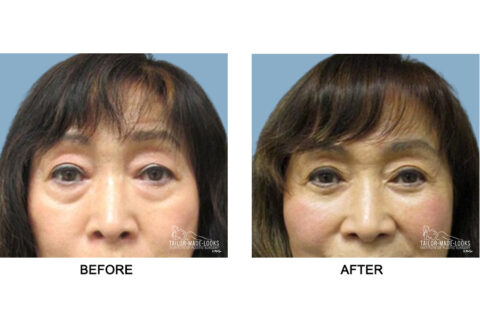 Asian Blepharoplasty Image