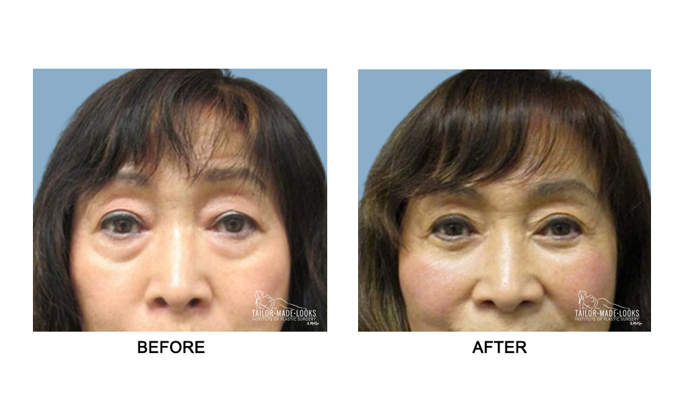 Asian Blepharoplasty Image