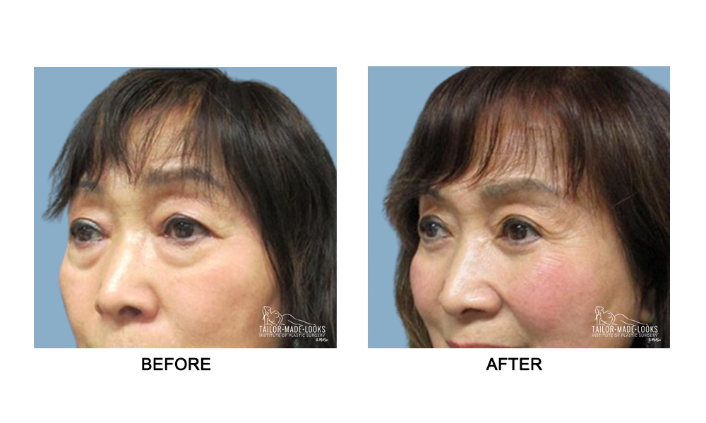 Asian Blepharoplasty Image