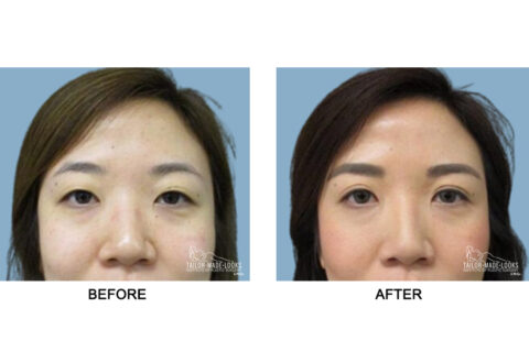 Asian Blepharoplasty Image