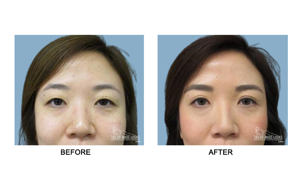 Asian Blepharoplasty Image