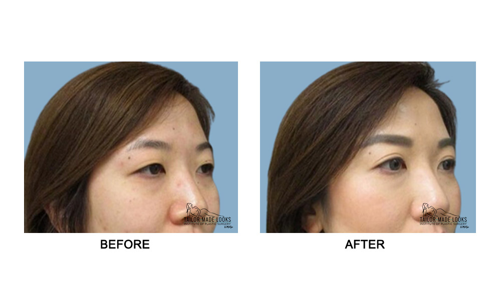 Asian Blepharoplasty Image