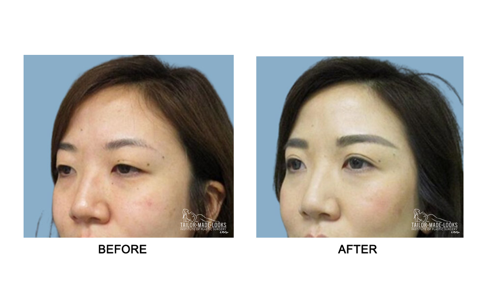 Asian Blepharoplasty Image