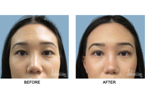 Asian Blepharoplasty Image