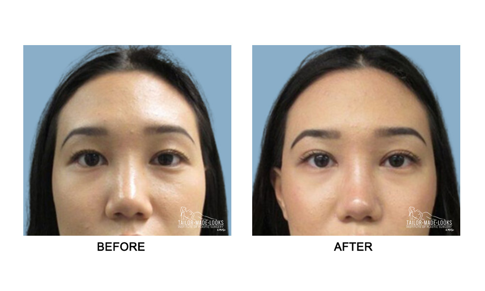 Asian Blepharoplasty Image