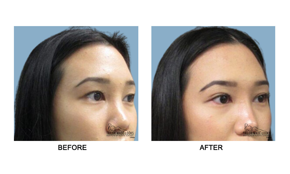 Asian Blepharoplasty Image