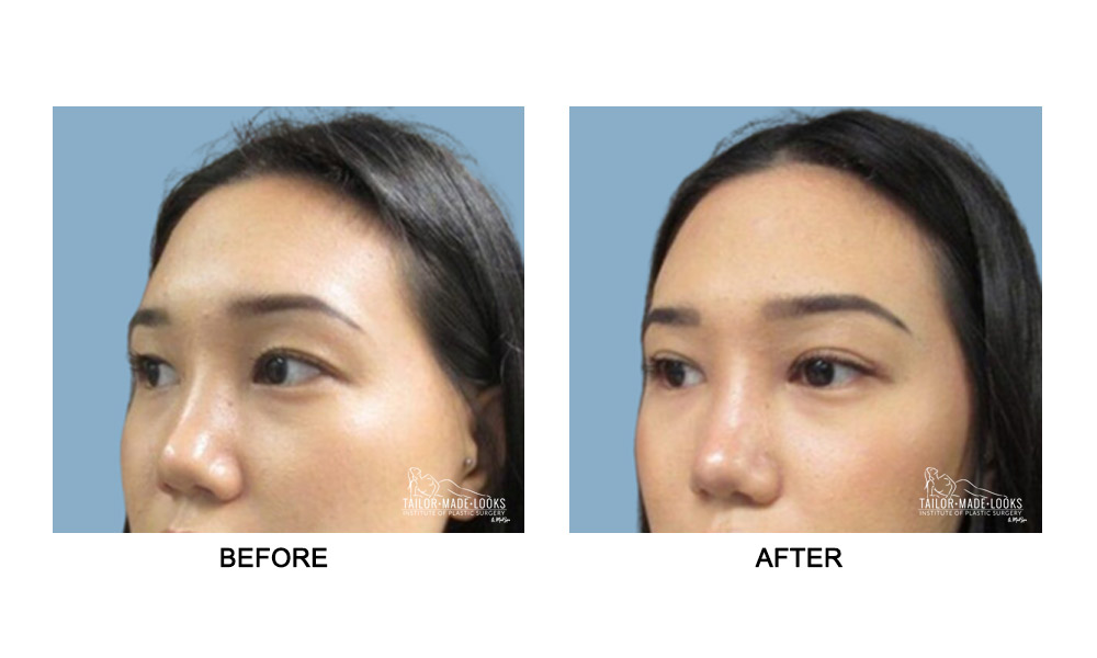 Asian Blepharoplasty Image