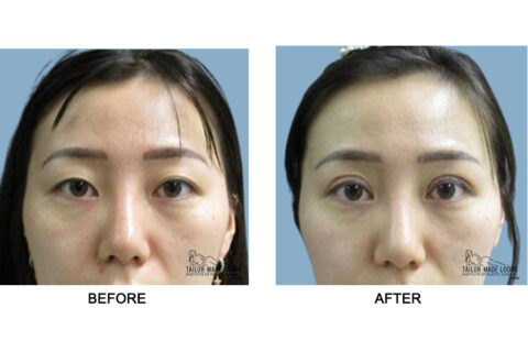 Asian Blepharoplasty Image