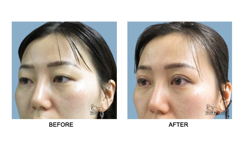 Asian Blepharoplasty Image