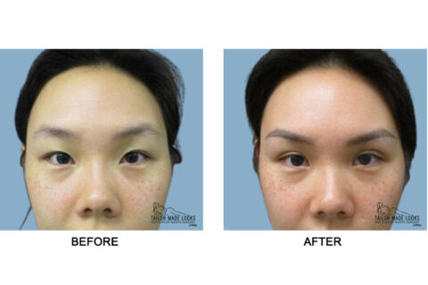 Asian Blepharoplasty Image