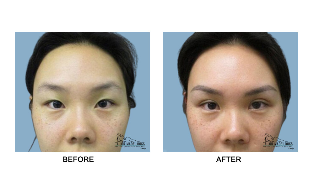 Asian Blepharoplasty Image