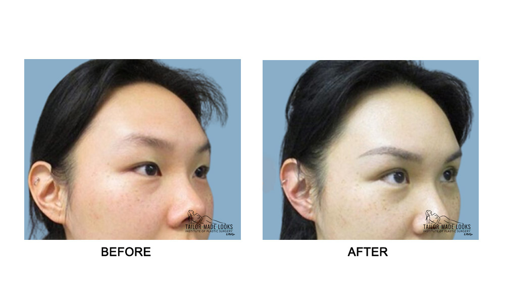 Asian Blepharoplasty Image